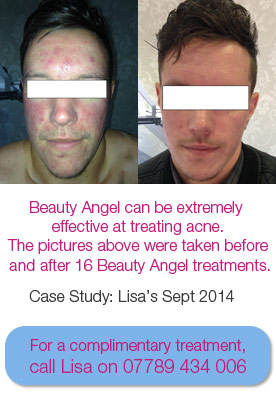 Beauty Angel acne skin treatments