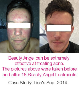 Beauty Angel skin treatments